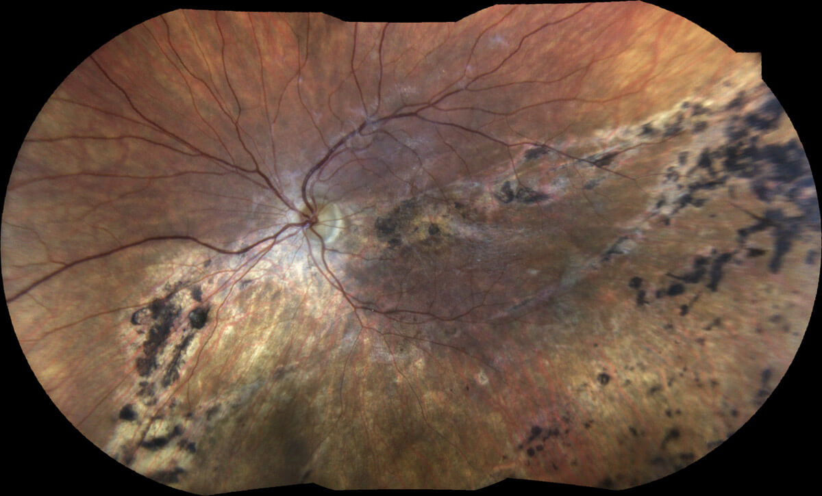 Retinal Detachement - courtesy of Dr. V. Sarao/ Prof. P. Lanzetta, IEMO, Udine, Italy.